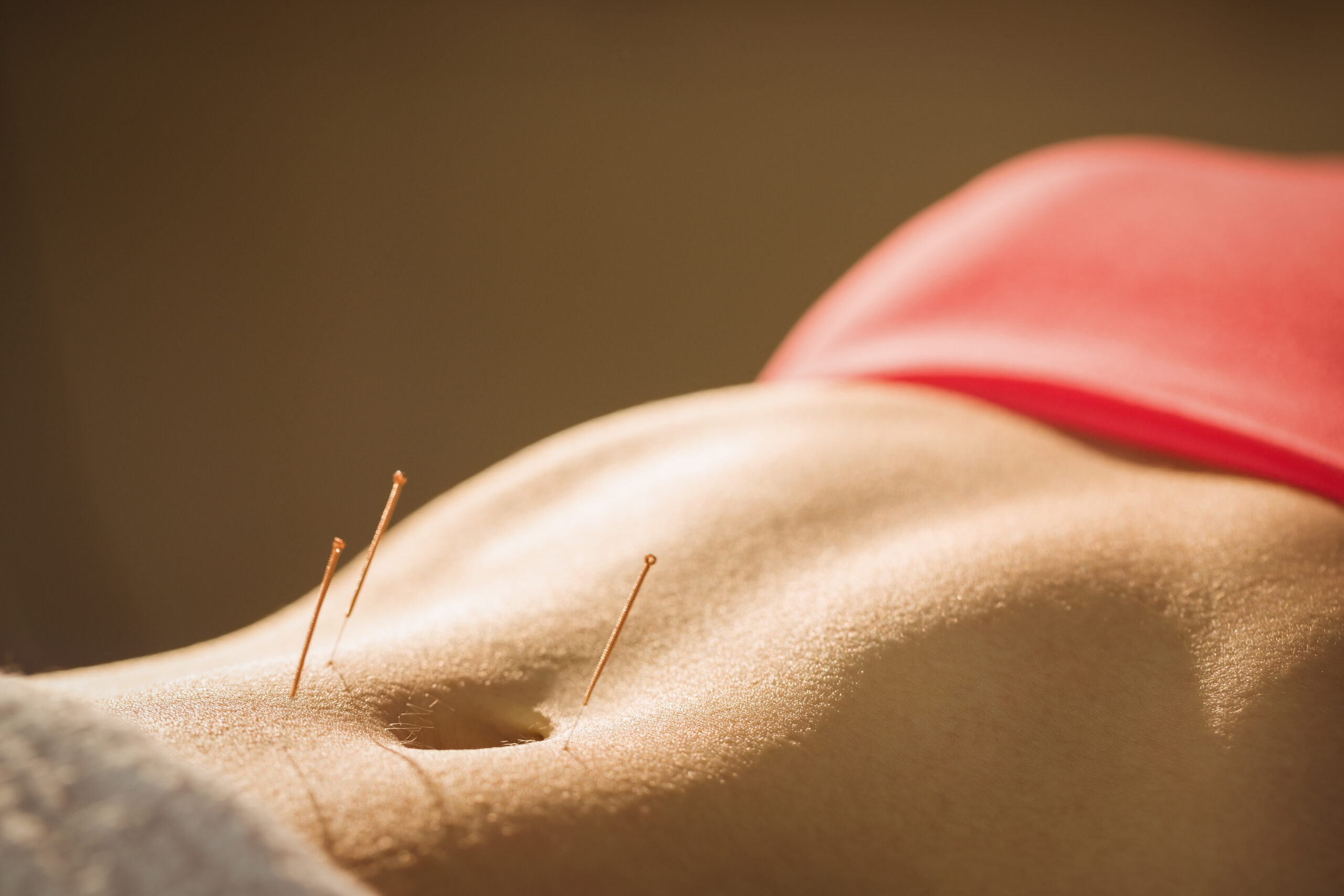 Young woman getting acupuncture treatment in therapy room