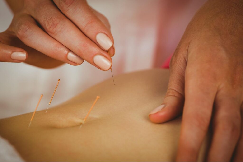 Can Acupuncture Help With Weight Loss?